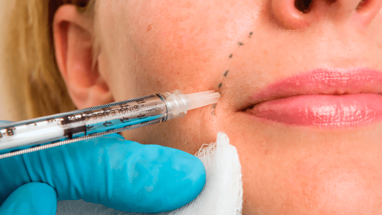 Dermal Filler Do's And Don'ts For Wrinkles, Lips And More