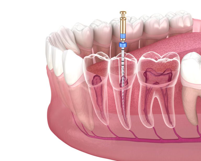 Root Canal A Step By Step Guide To Helping Your Child