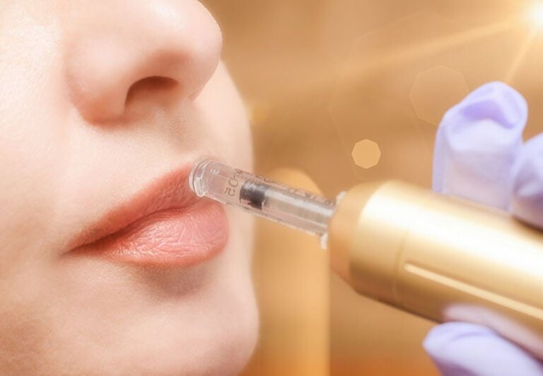 The Dangers Of Hyaluron Pen Lip Fillers – Cleveland Clinic