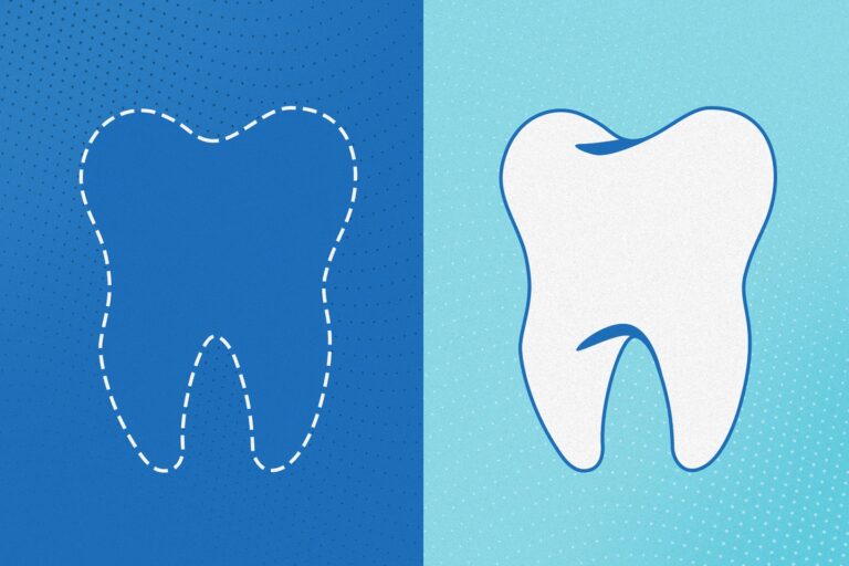 Wisdom Tooth Extraction Is Common. Not Everyone Agrees That It