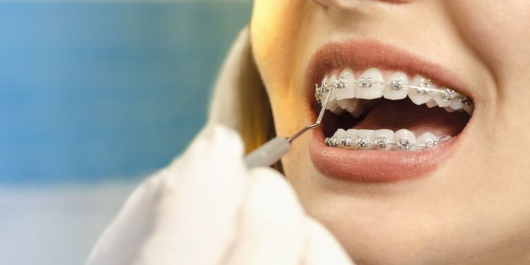 7 Things You Need To Know About Adult Braces