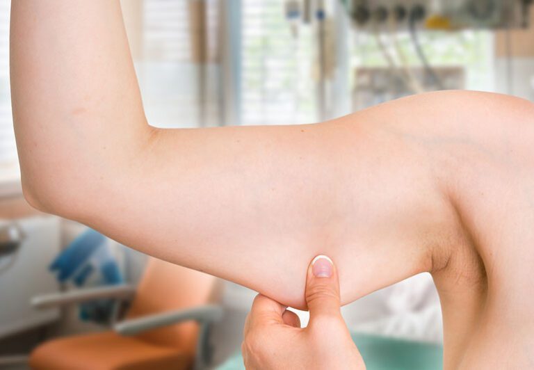 Are You Considering Arm Lift Surgery? Facts You Should Know