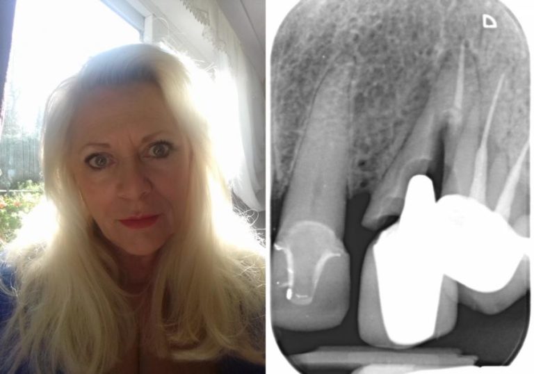 Chorley Woman Awarded £13,000 For Poor Dental Treatment