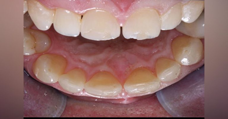 Crowns Vs Veneers | Dental Economics