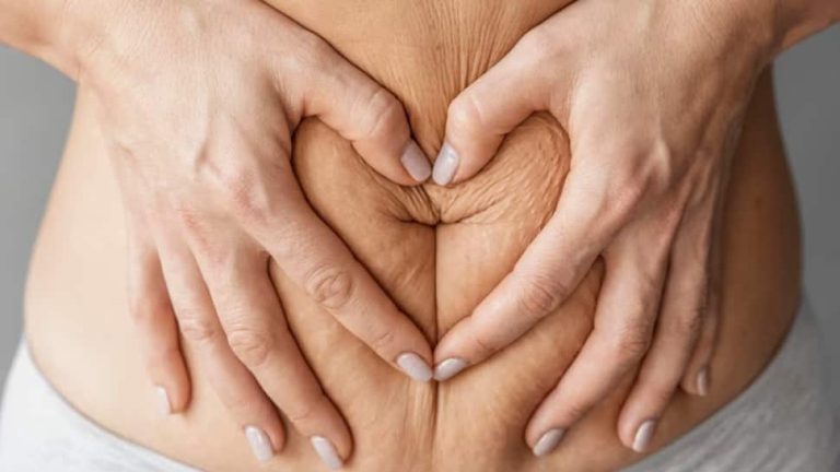 Exclusive: What Is A Tummy Tuck? Expert Shares 5 Things