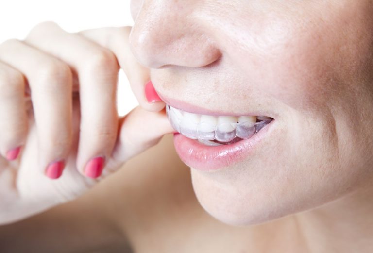 How To Clean And Care For Invisalign And Other Aligners