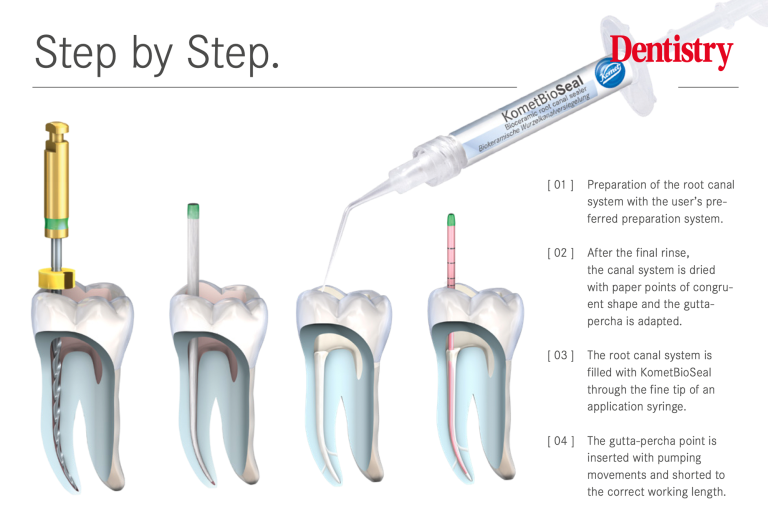 Kometbioseal – The New Bioceramic Root Filling Sealant