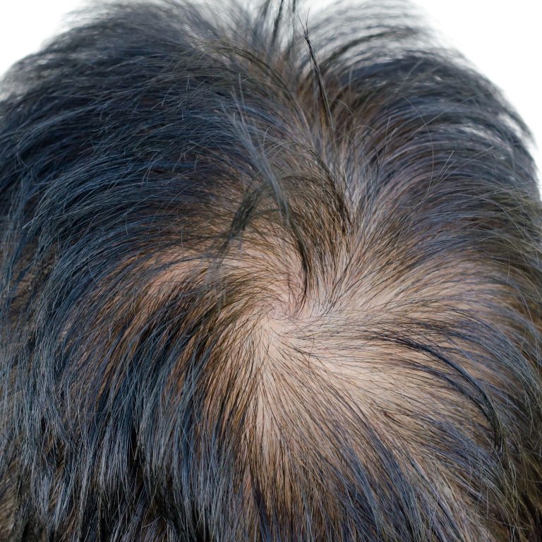 Minoxidil Combined With Laser Therapy Improves Hair Condition In Androgenetic