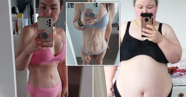 Mom Sheds 13 Pounds Of Excess Skin After 13 Pounds