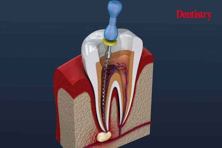 Stay Safe With Root Treatment