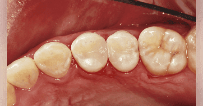 The Most Challenging Daily Restoration Problem: A Case Study In