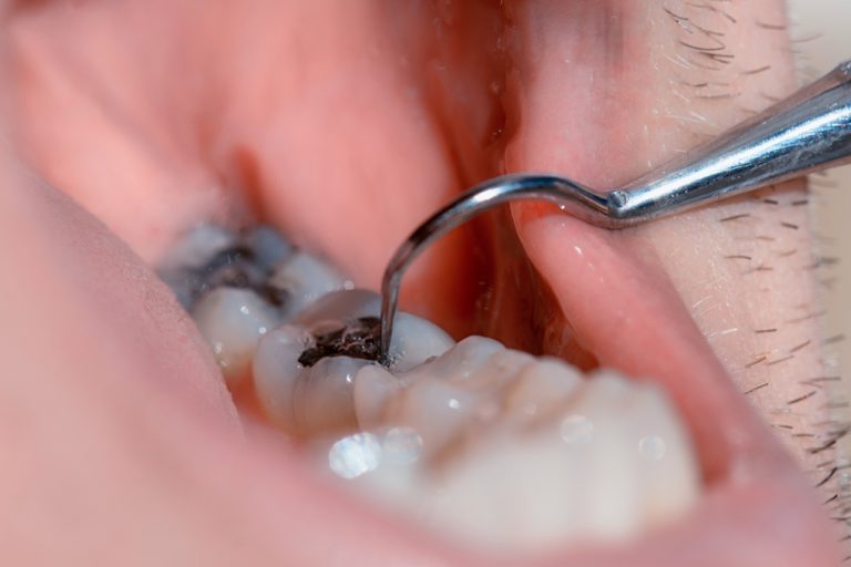 The Use Of Dental Amalgam In Fillings Decreases Significantly In