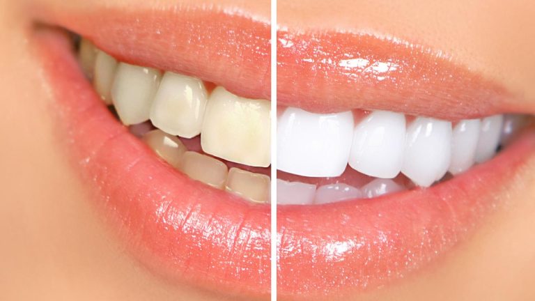 Top 5 Teeth Whitening Products To Get Your Brightest Smile