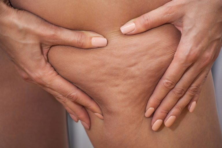 Exploring Topical Cellulite Creams