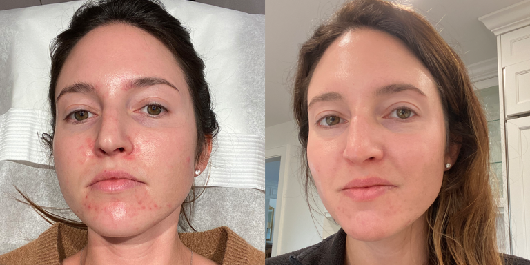 I Tried Chemical Peels To Treat Acne