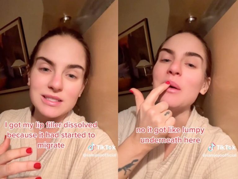 Jojo Reveals What Happened When Her Lip Filler Started 'migrating'