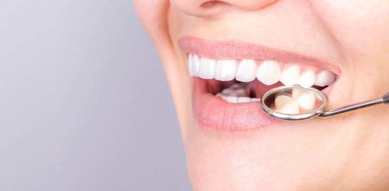 Smile! What Are Veneers And What Do They Do To