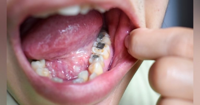 Study: Use Of Dental Amalgam Fillings Reduced By 73% In