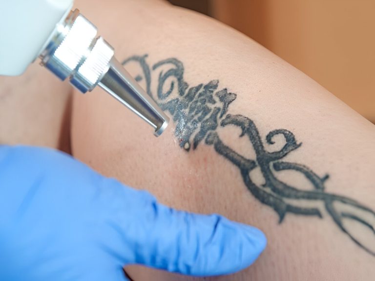 Tattoo Regrets? Here Are Some Tips For Safely Removing Old