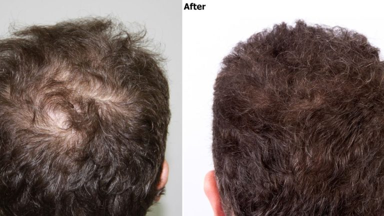 Estecapelli Unveils Exosome Hair Transplant Method In Europe