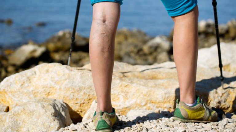 What Causes Varicose Veins And How To Treat Them