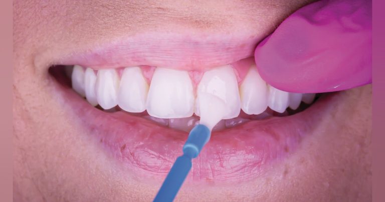 Fluoride Varnishes: What's The Difference And Which Is Best?