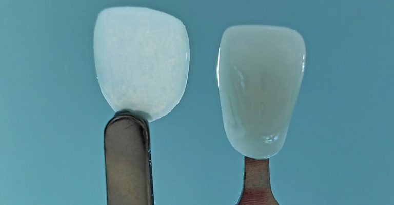 Introducing Ultrathineer, The Thinnest Dental Veneers In The World