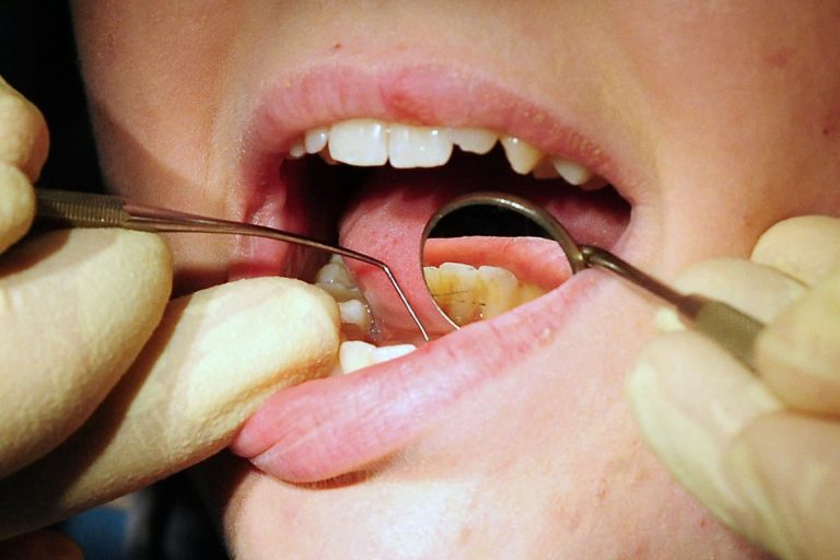 Number Of Rotten Teeth Removed From Children In Hospital Rises