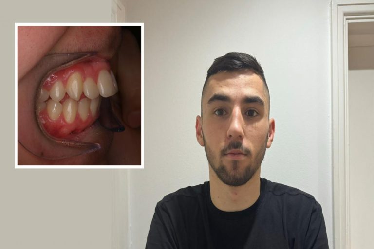 Student Left 'terrified' After Teeth Started Falling Out After Getting