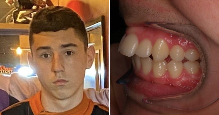 Teenager Receives £11,000 Payout After Teeth Fell Out Of Braces