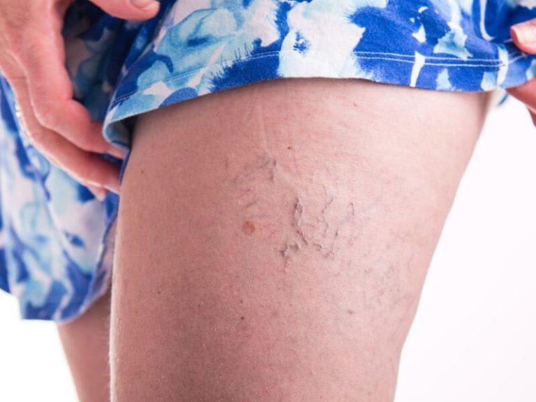 What Works Best Against Varicose Veins?