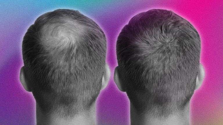 The Great Baldness Debate: Hair Transplant Or Scalp Micropigmentation?