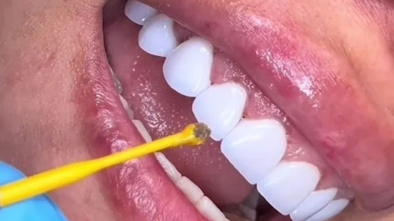 'that's Why Veneers Have Bad Breath,' Says Onlookers As Dentist