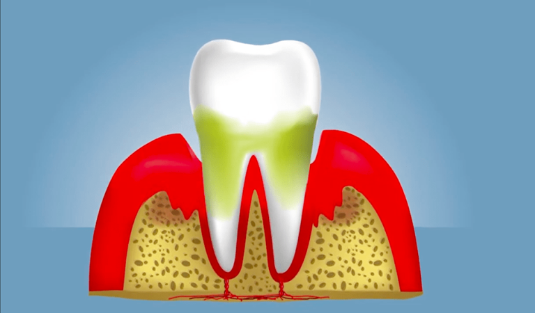 Musc Research Shows Statins May Help Fight Gingivitis | Musc