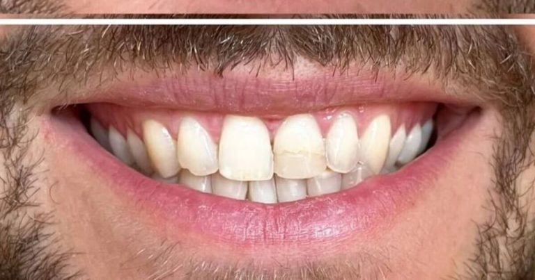 Teeth Whitening Powder Claims To 'whiten In Weeks'