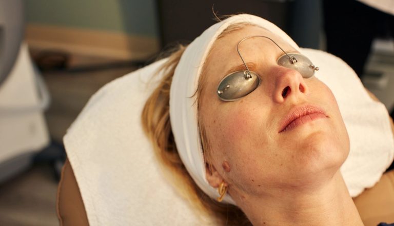 What You Need To Know About Facial Or Chemical Peels