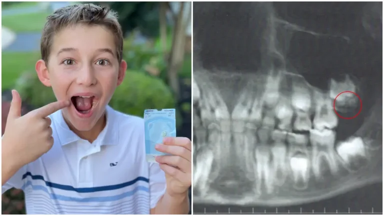 9 Year Old Becomes The Youngest Ever To Have A Wisdom Tooth