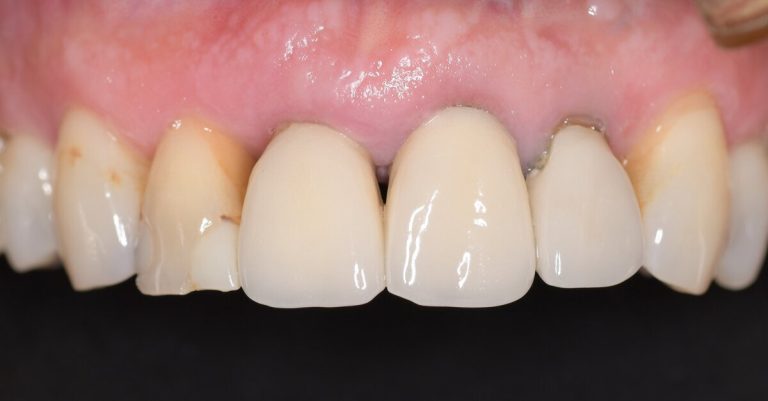 Implant Placement With Fully Guided Digital Workflow