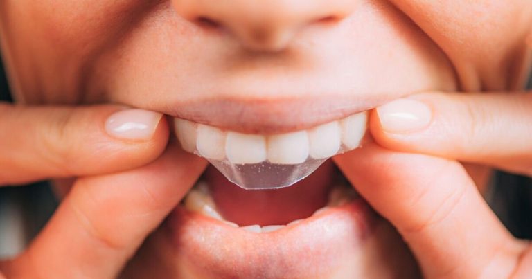 Buyers Recommend Teeth Whitening Products That Eliminate Stains