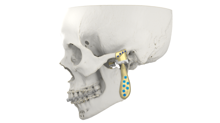 Materialise's New Tmj Arthroplasty System Brings Hope To Jaw Treatments