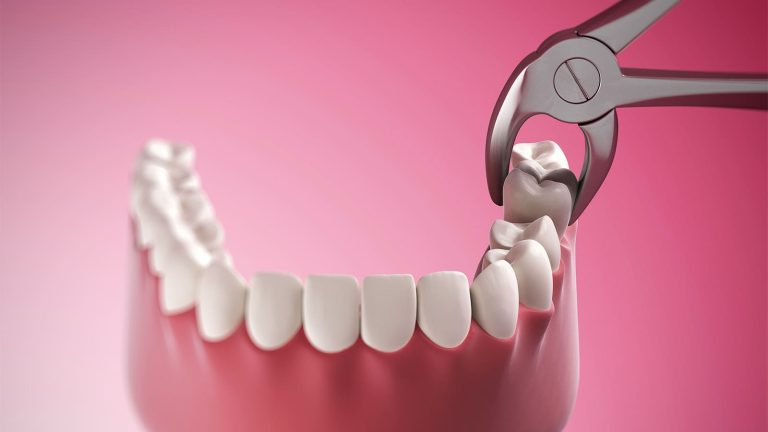 Missing Teeth And Joint Pain? Ra May Be Imminent