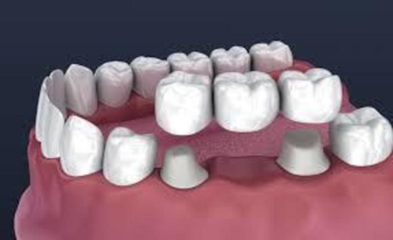 The Market For Dental Crowns And Bridges Is Growing Rapidly