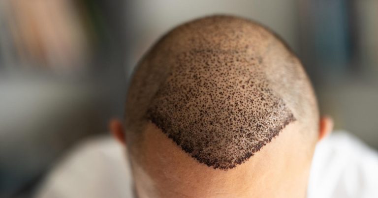 Considering A Hair Transplant? This Is Where Many Americans Are