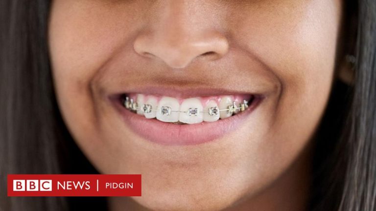 Fashion Braces: E Don Turn Trend For Nigeria?