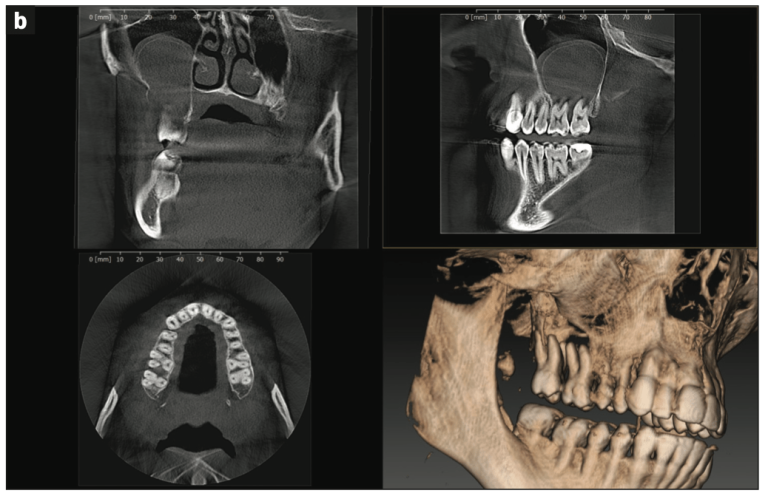 From Implant Placement To Emergency Intervention