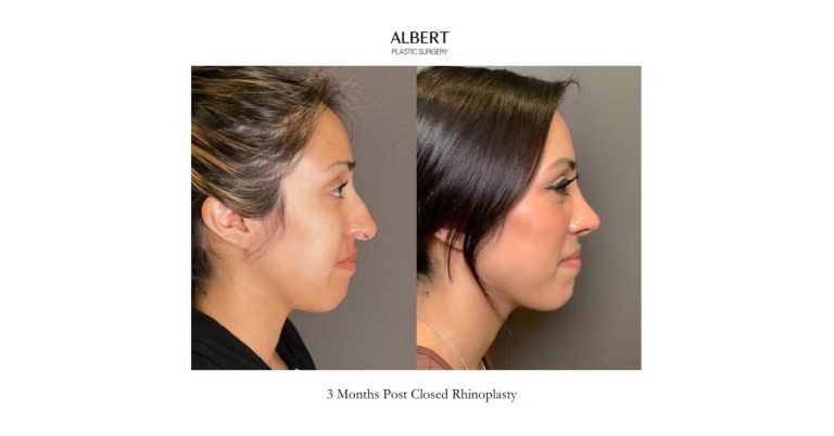 Revolutionary Closed Rhinoplasty Procedure Albert Plastic Surgery