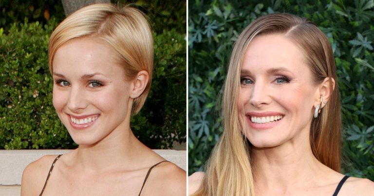 Did Kristen Bell Get Veneers? The Doctor Shares If He