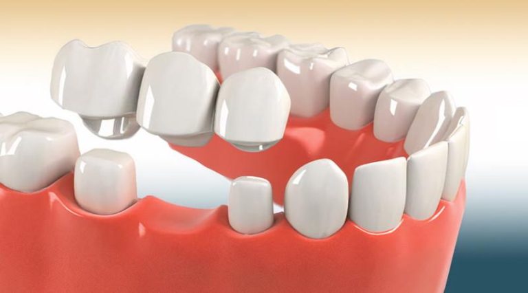 Dental Crowns And Bridges Market Key Trends Analysis 2024,