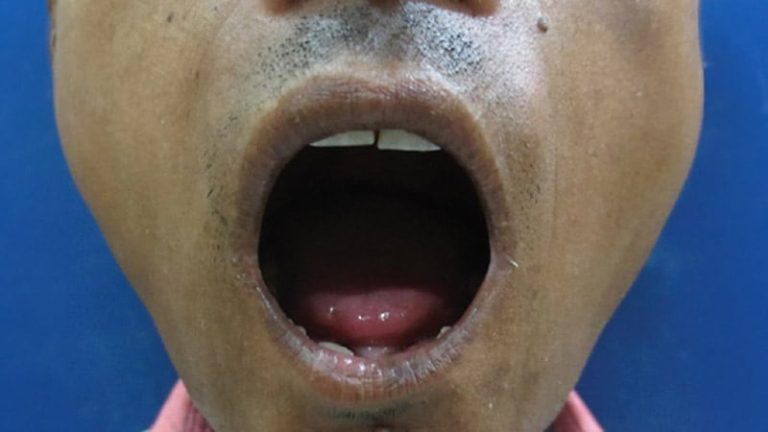 Management Of Orofacial Changes In Scleroderma