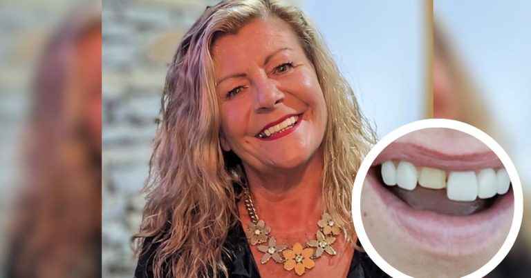 The Caerphilly Woman's Medical History Indicated That Veneers Were Not